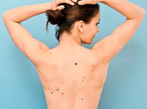 moles on your body meaning